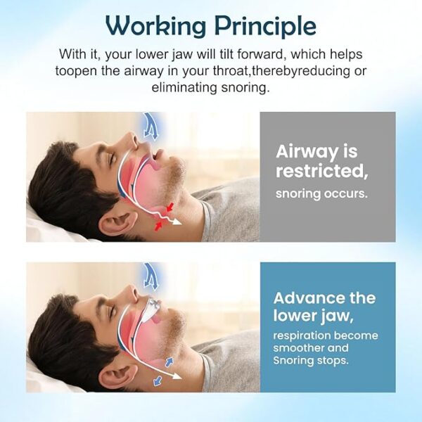 Anti Snoring Mouthpiece - Anti SnoringMouthpiece Device Mouth Guard,Snore Reduction Device for Men and Women, Comfortable Mouth Guard for Better Sleep, 1 Pack (Blue)-ZHA5 - Image 6